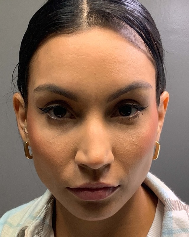 Botox Before & After