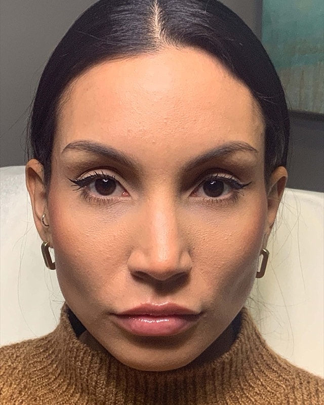 Botox Before & After
