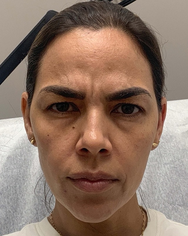 Botox Before & After