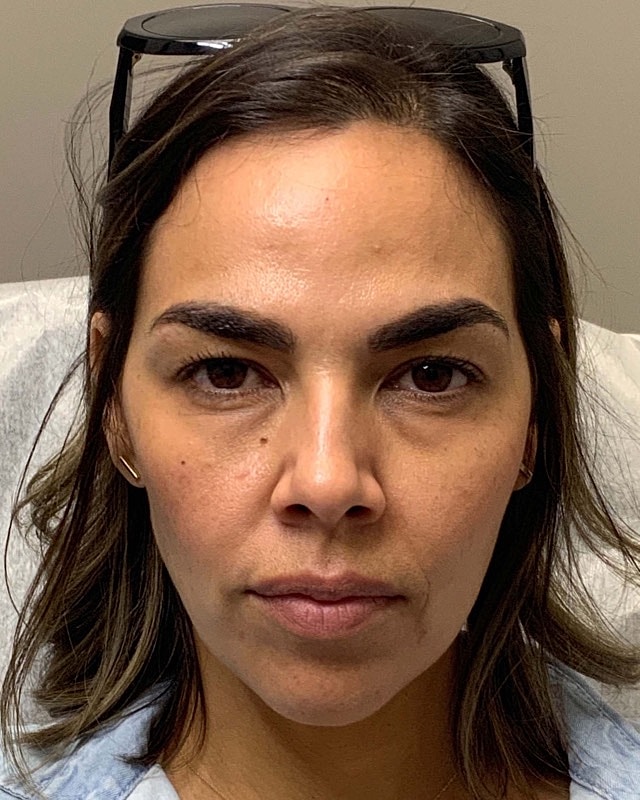 Botox Before & After