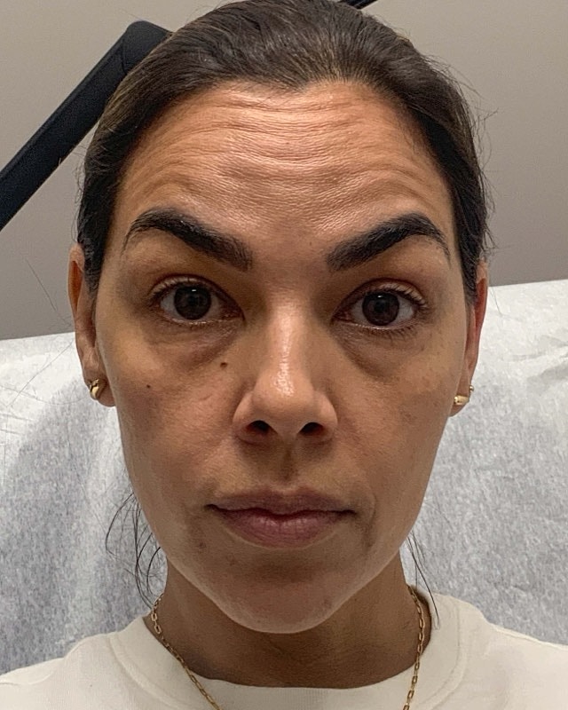 Botox Before & After