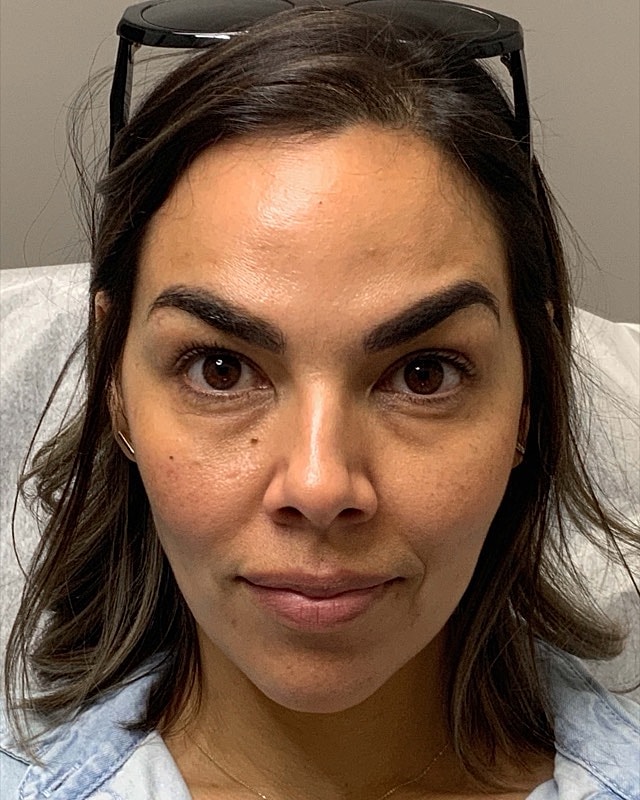 Botox Before & After