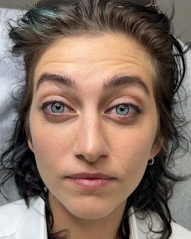 Botox Before & After