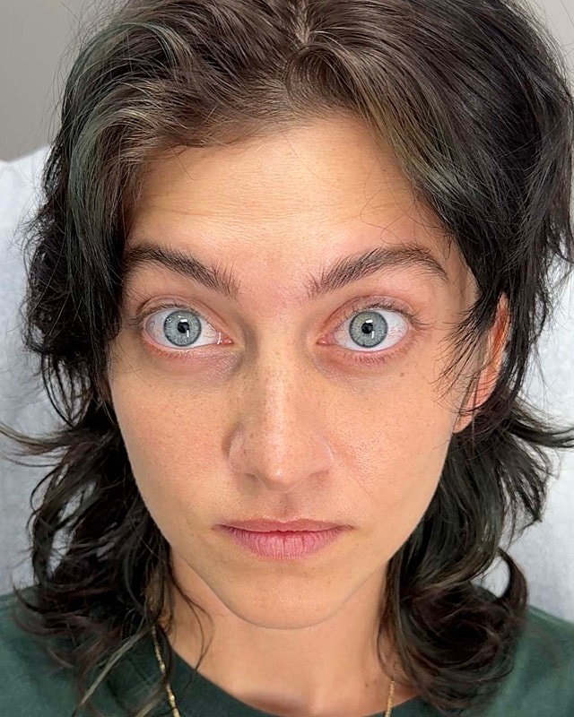 Botox Before & After