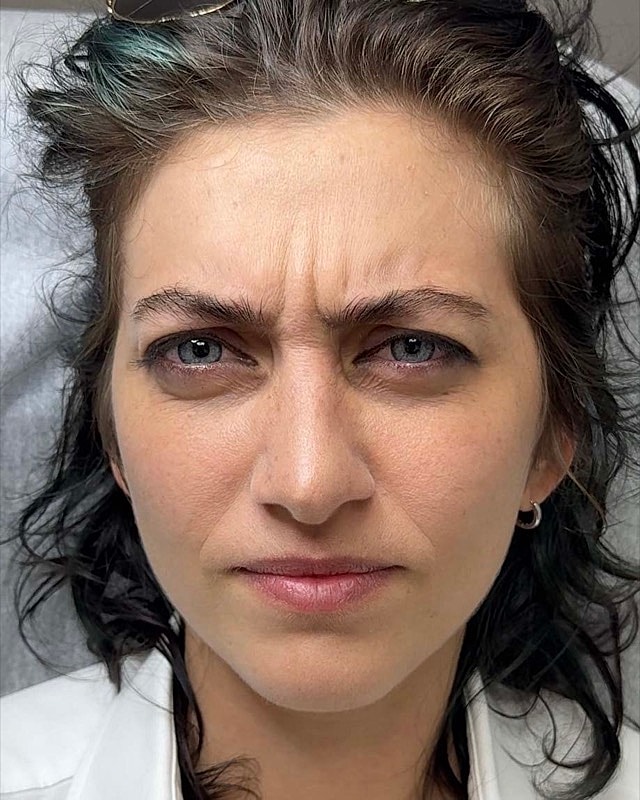 Botox Before & After