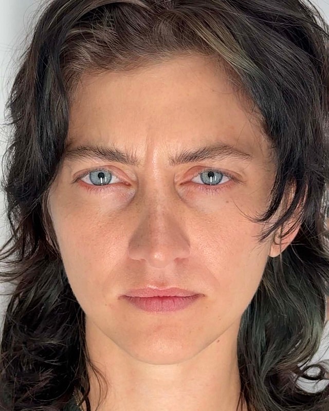 Botox Before & After