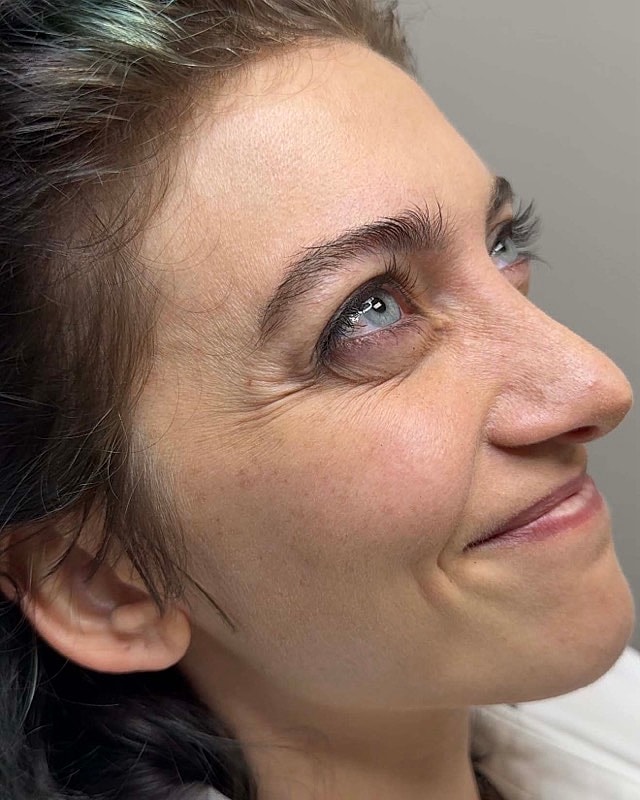Botox Before & After
