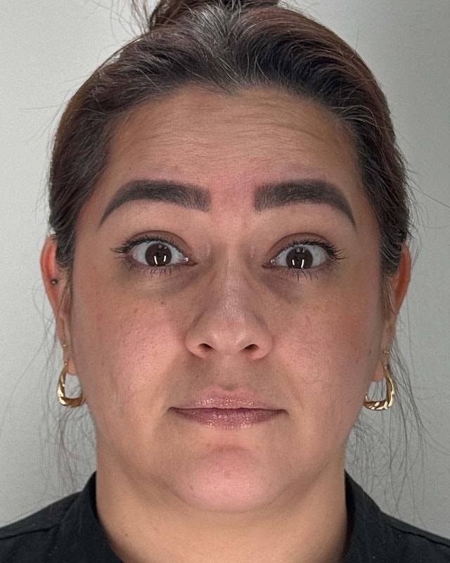 Botox Before & After