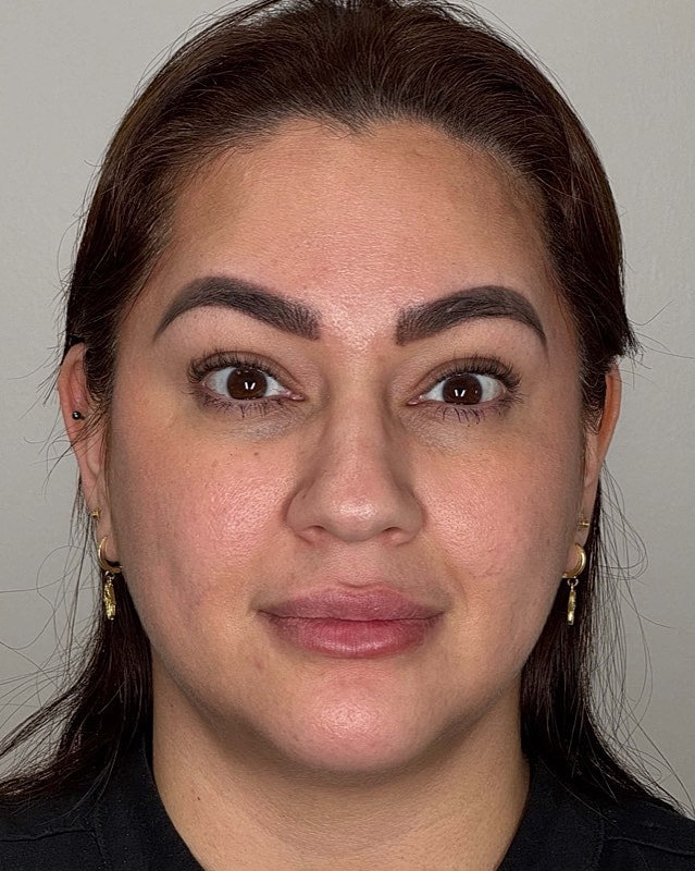 Botox Before & After