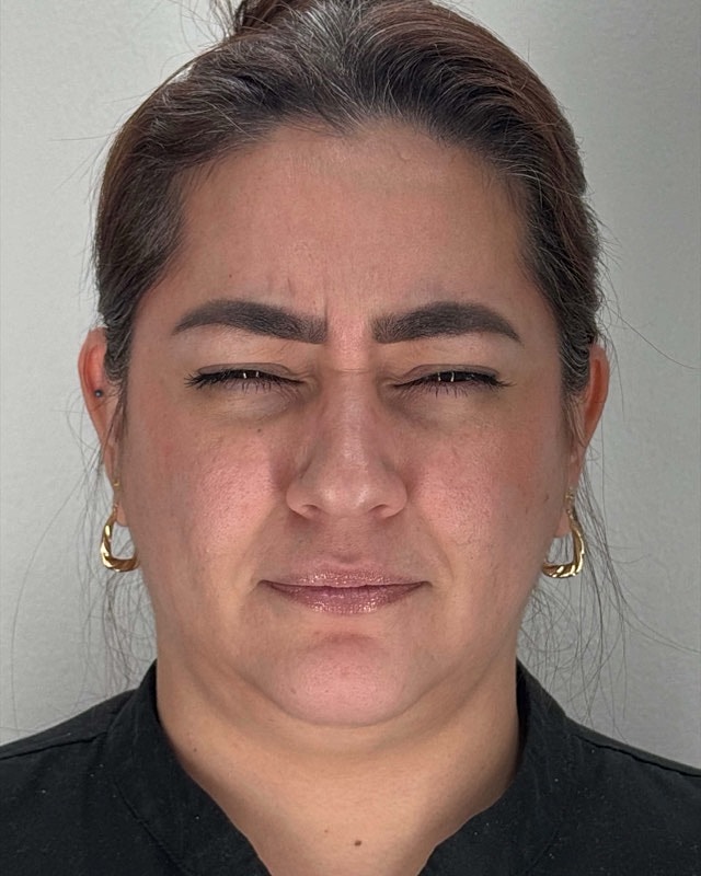 Botox Before & After