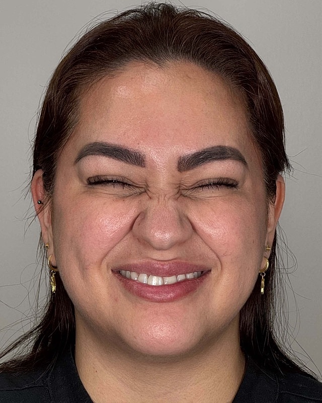 Botox Before & After