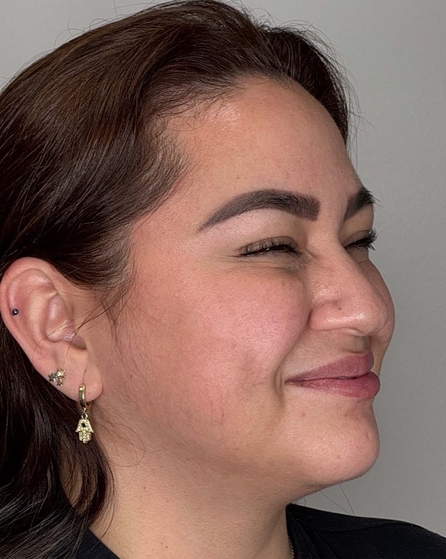 Botox Before & After