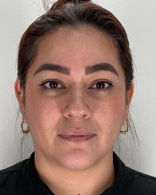 Botox Before & After