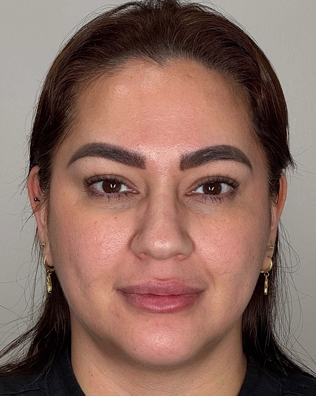 Botox Before & After