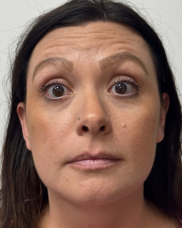 Botox Before & After