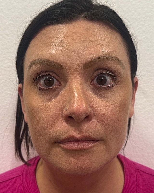 Botox Before & After