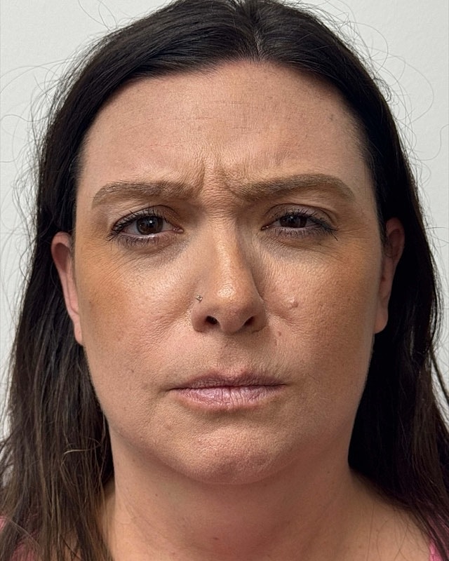 Botox Before & After