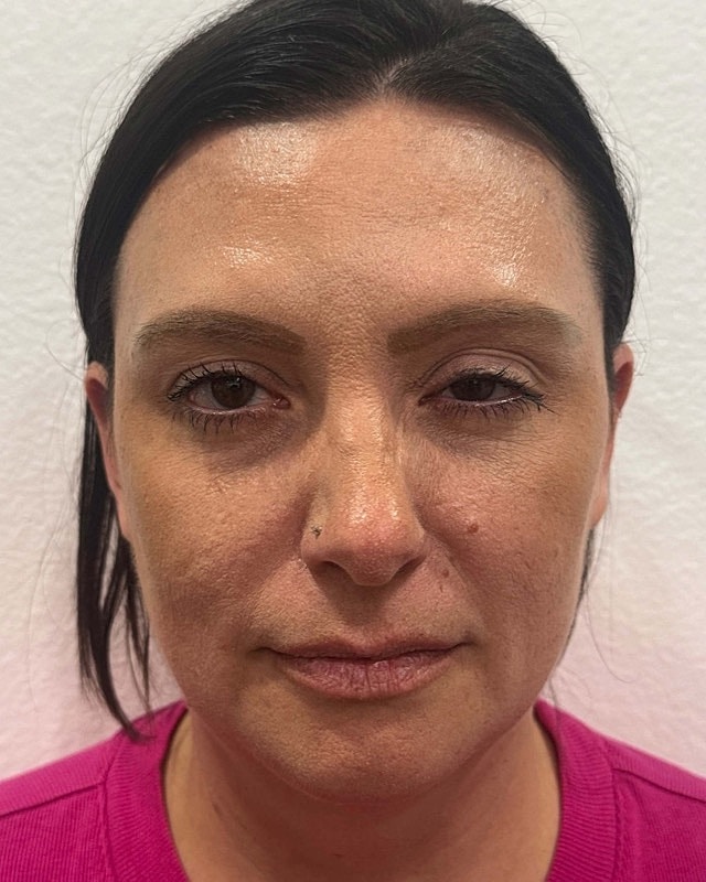 Botox Before & After