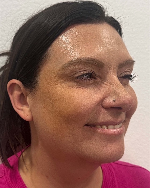 Botox Before & After