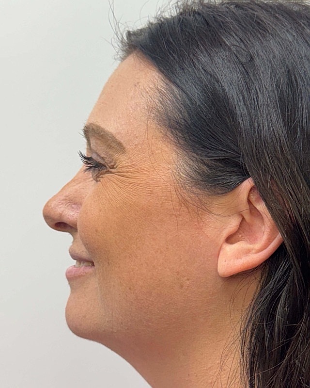 Botox Before & After