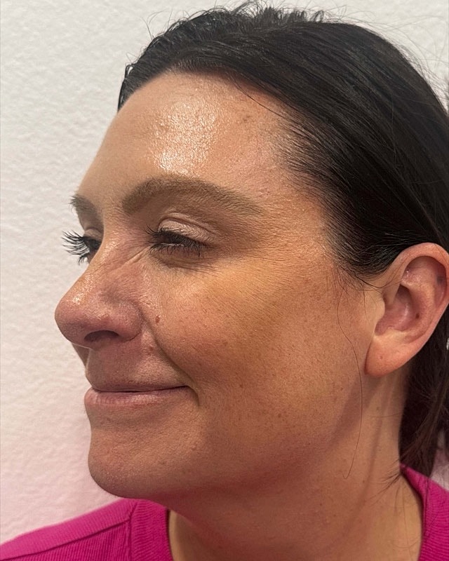 Botox Before & After