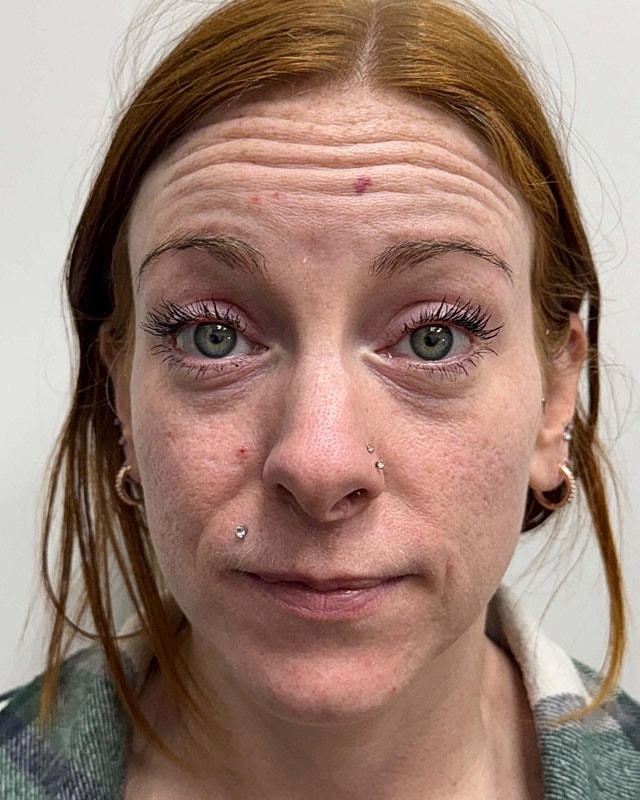 Botox Before & After