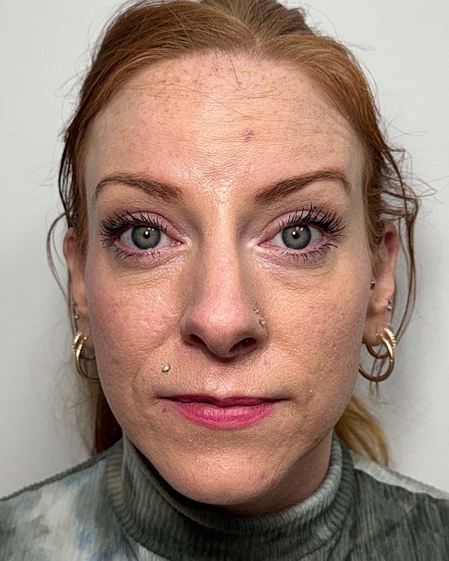Botox Before & After