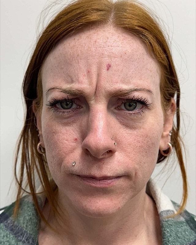 Botox Before & After