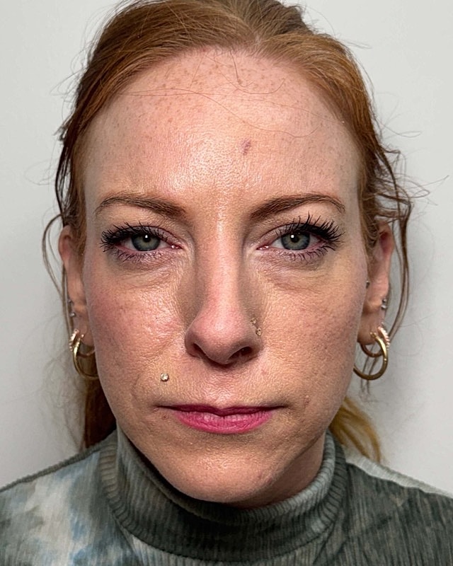 Botox Before & After