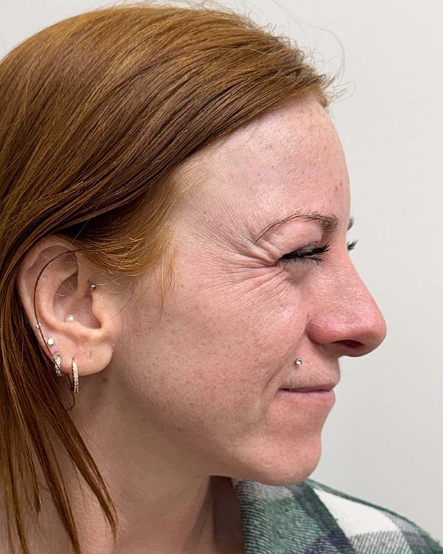 Botox Before & After