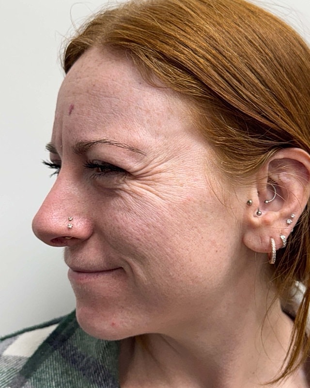 Botox Before & After