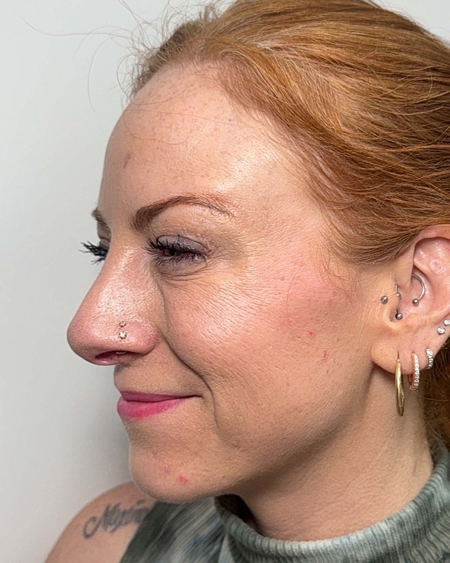 Botox Before & After