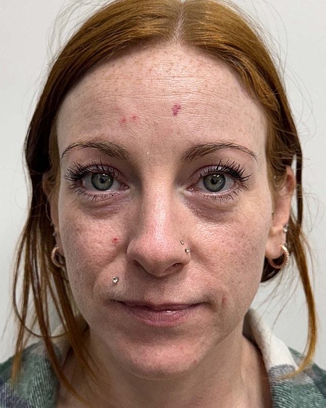 Botox Before & After