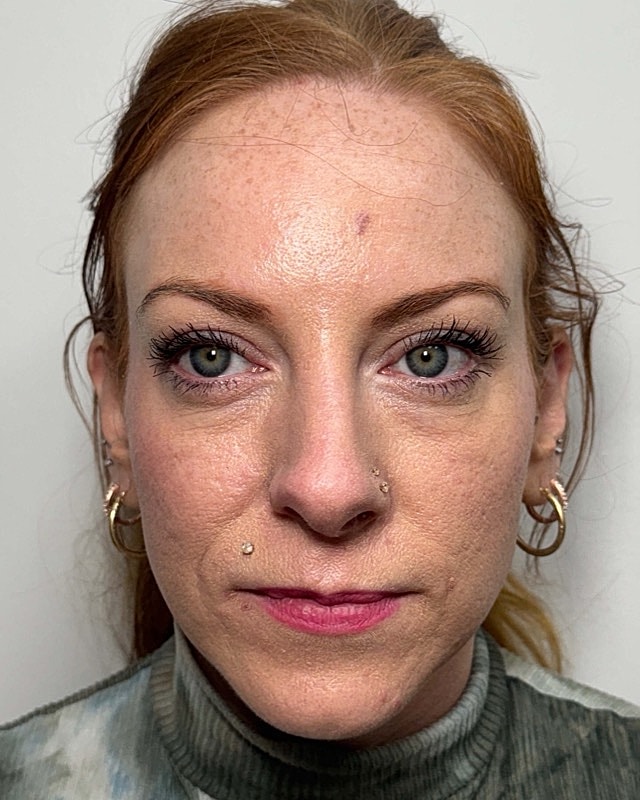 Botox Before & After