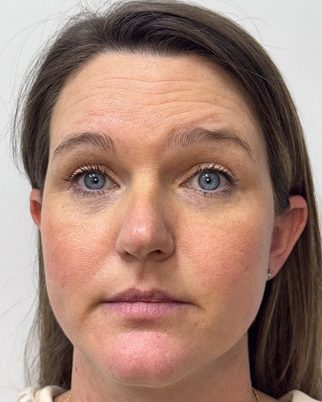 Botox Before & After