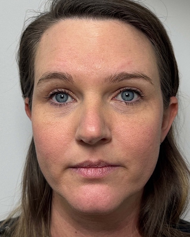 Botox Before & After