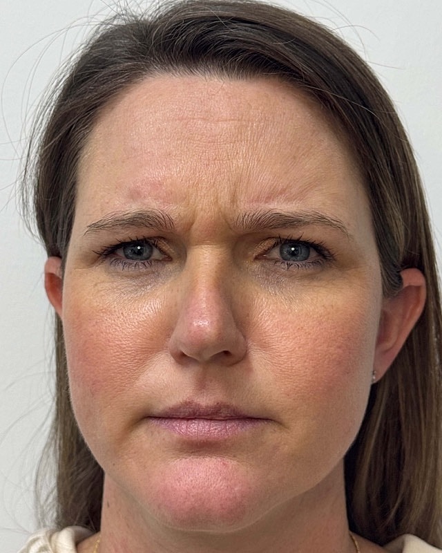 Botox Before & After