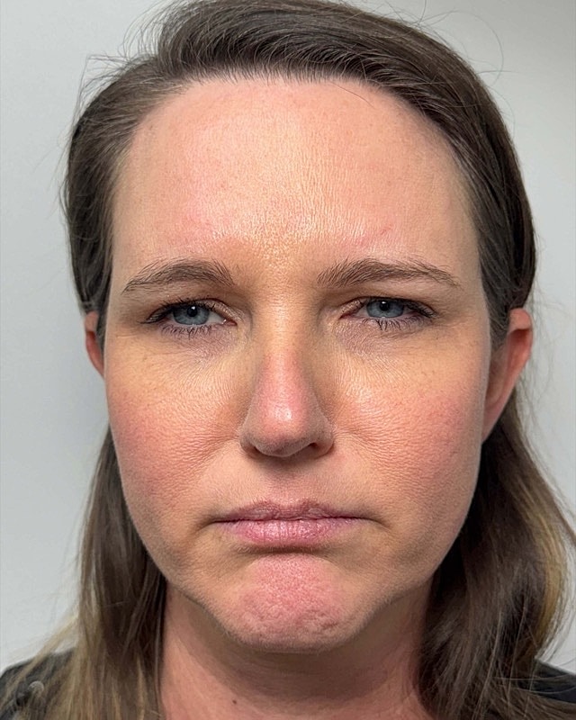 Botox Before & After