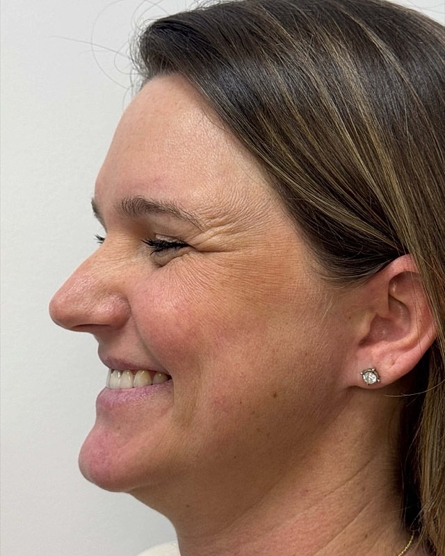 Botox Before & After