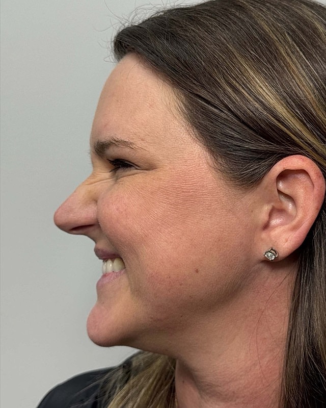 Botox Before & After