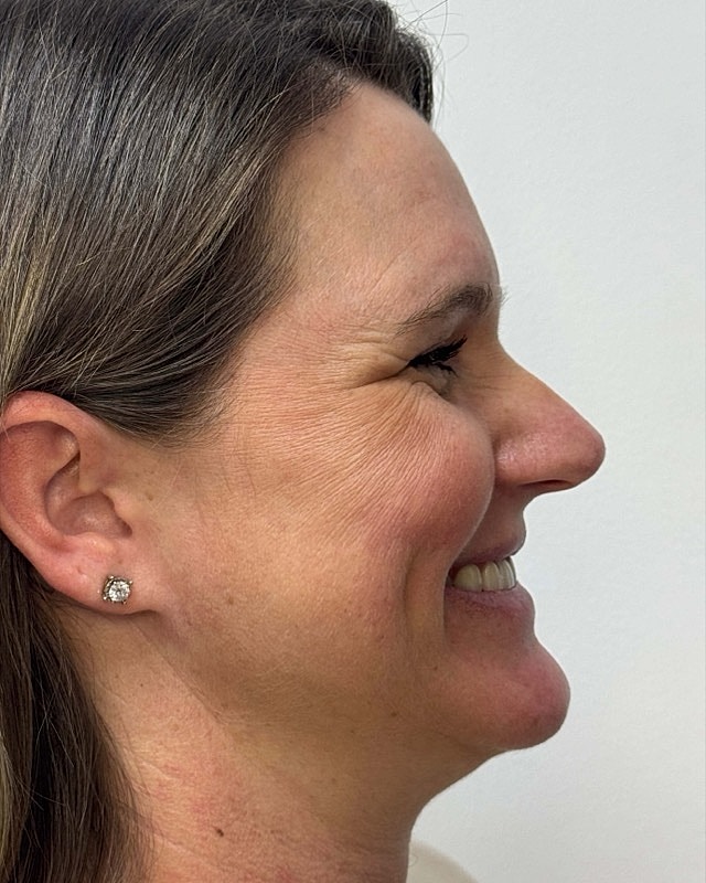 Botox Before & After