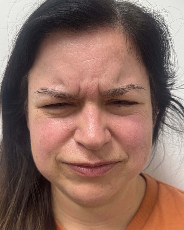Botox Before & After