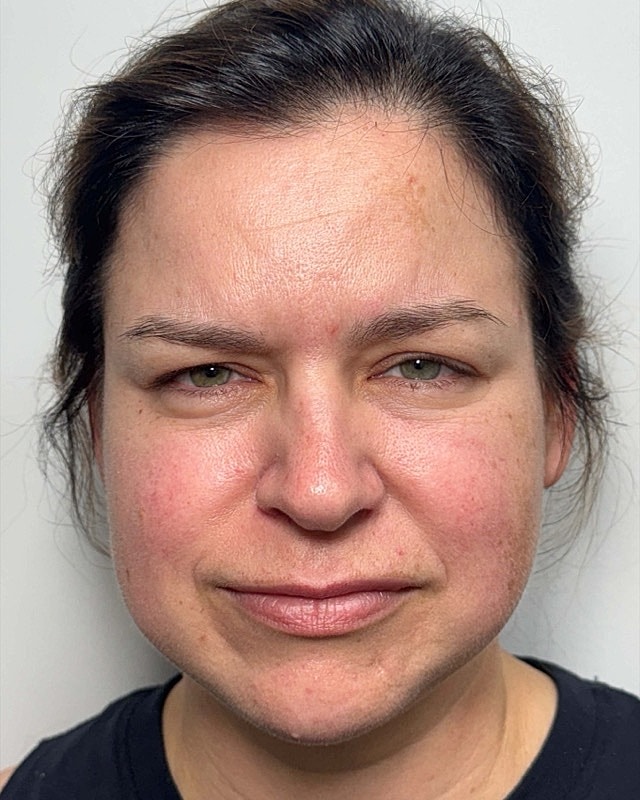 Botox Before & After