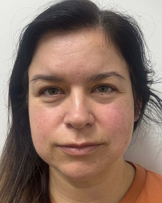 Botox Before & After