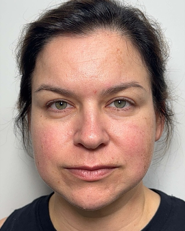Botox Before & After