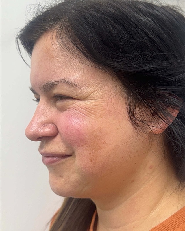 Botox Before & After