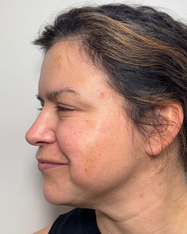 Botox Before & After