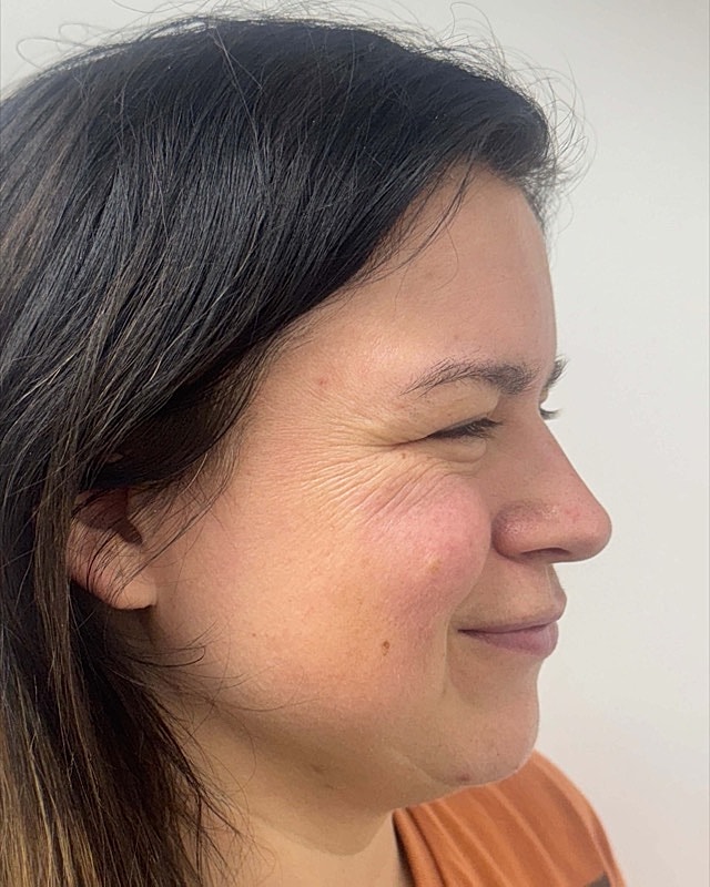 Botox Before & After