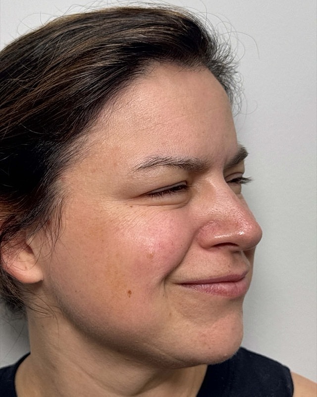 Botox Before & After