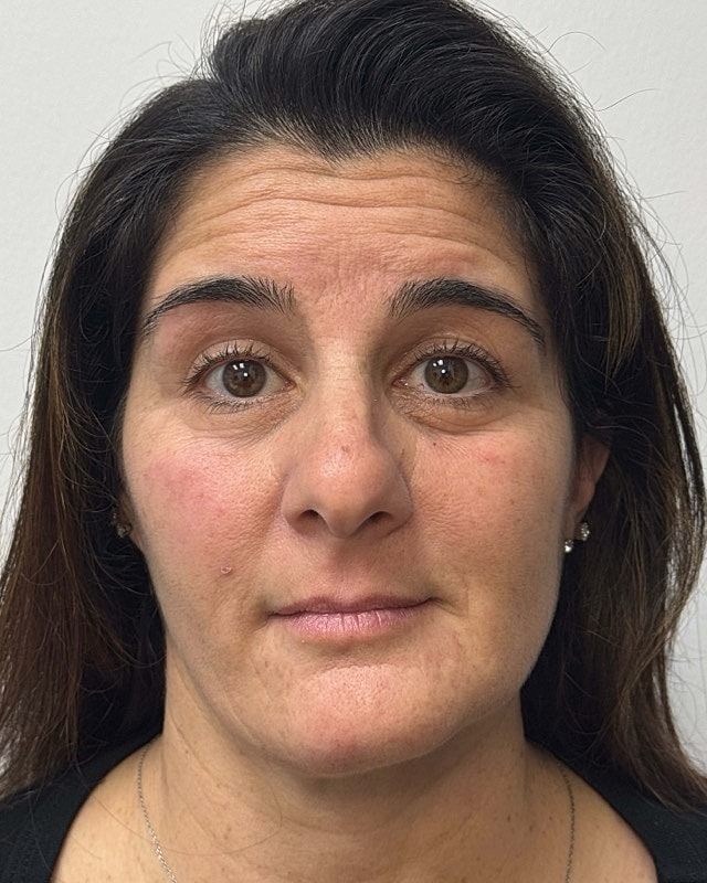 Botox Before & After